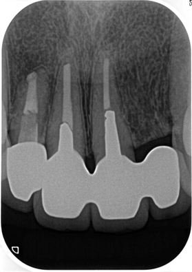 延長ブリッジ - EE DENTAL_Blog